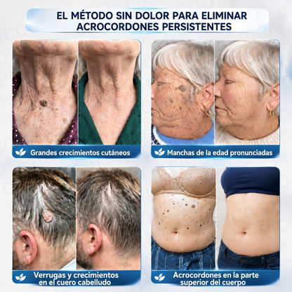 🪻💖𝐏𝐢𝐜𝐝𝐨® 𝑪𝒓𝒆𝒎𝒂 𝑩𝒐𝒓𝒓𝒂𝒅𝒐𝒓𝒂 𝒅𝒆 𝑨𝒄𝒓𝒐𝒄𝒐𝒓𝒅𝒐𝒏𝒆𝒔 𝒚 𝑴𝒂𝒏𝒄𝒉𝒂𝒔 𝒆𝒏 7 𝑫í𝒂𝒔 (𝐹ó𝑟𝑚𝑢𝑙𝑎 𝑠𝑖𝑛 𝑑𝑜𝑙𝑜𝑟 𝑛𝑖 𝑐𝑖𝑐𝑎𝑡𝑟𝑖𝑐𝑒𝑠)